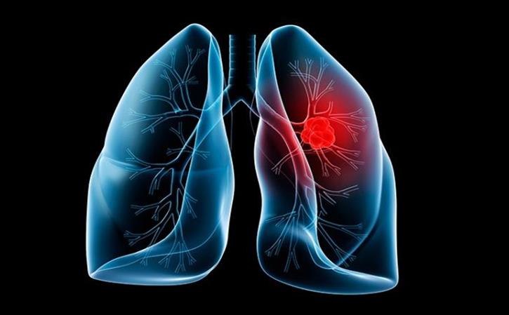 Silicosis - Lung fibrosis caused by inhalation of silica particles